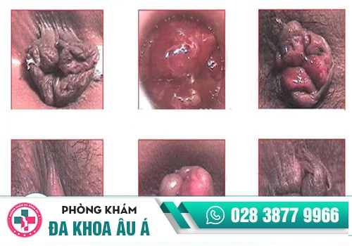 Bệnh trĩ gây ra nhiều hệ lụy nguy hiểm cho người bệnh