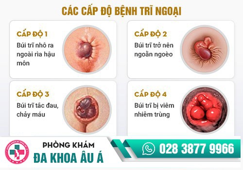 cấp độ bệnh trĩ