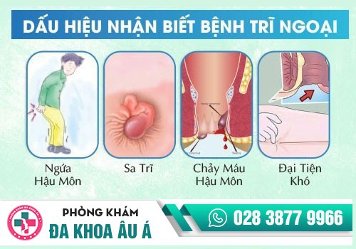 BỆNH TRĨ NGOẠI LÀ GÌ?