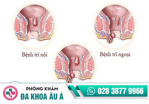 Trĩ nội và trĩ ngoại 