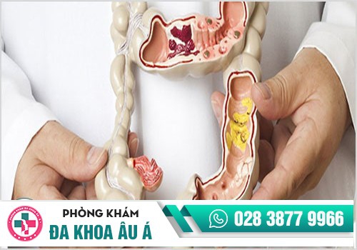 NHỮNG BỆNH HẬU MÔN CẦN KHÁM NGAY