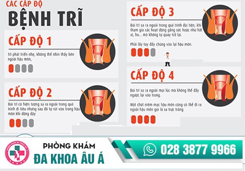 BỆNH TRĨ TẠI SAO PHẢI CẮT?